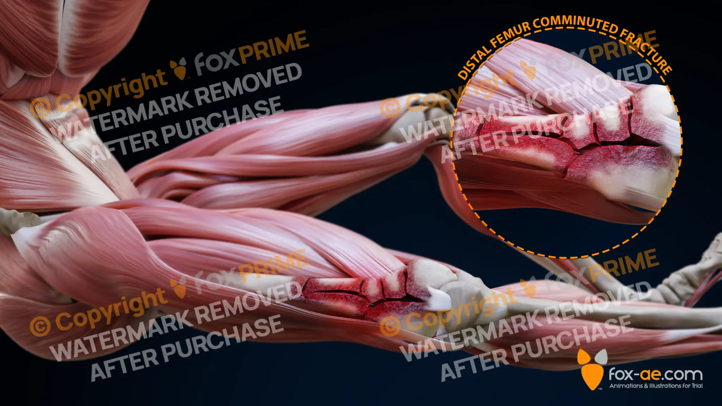 Right Distal Femur Comminuted Fracture Still Shot