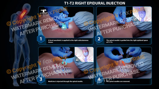 Right Epidural Injection T1-T2 (PowerPoint) - PowerPoint