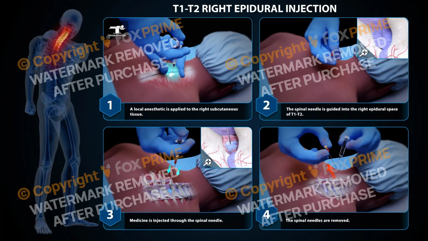 Right Epidural Injection T1-T2 - Still Shot