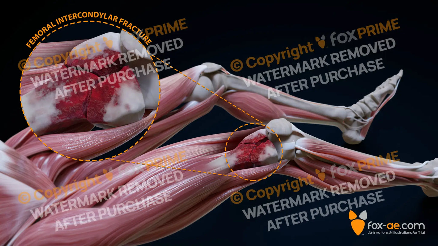Right Femoral Intercondylar Fracture Still Shot