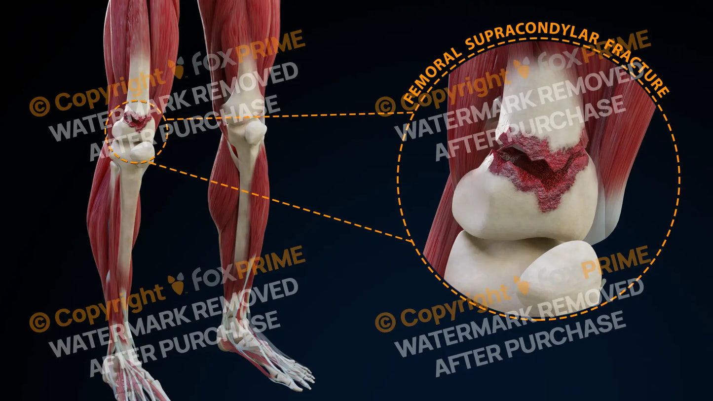 Right Femoral Supracondylar Fracture Still Shot