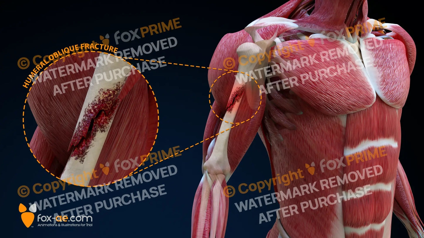 Right Humeral Oblique Fracture Still Shot