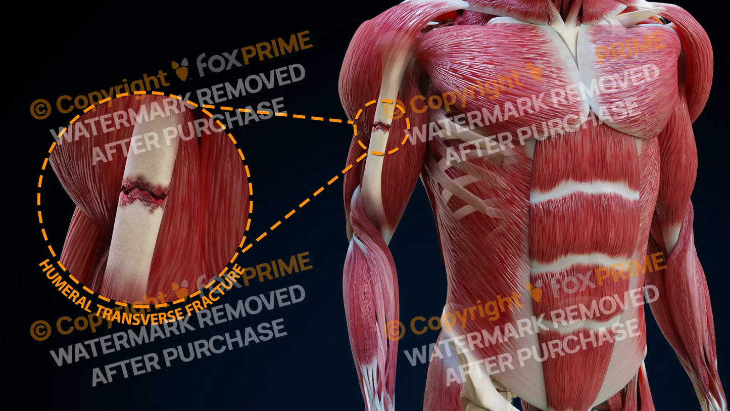 Right Humeral Transverse Fracture Single Use / Male Still Shot