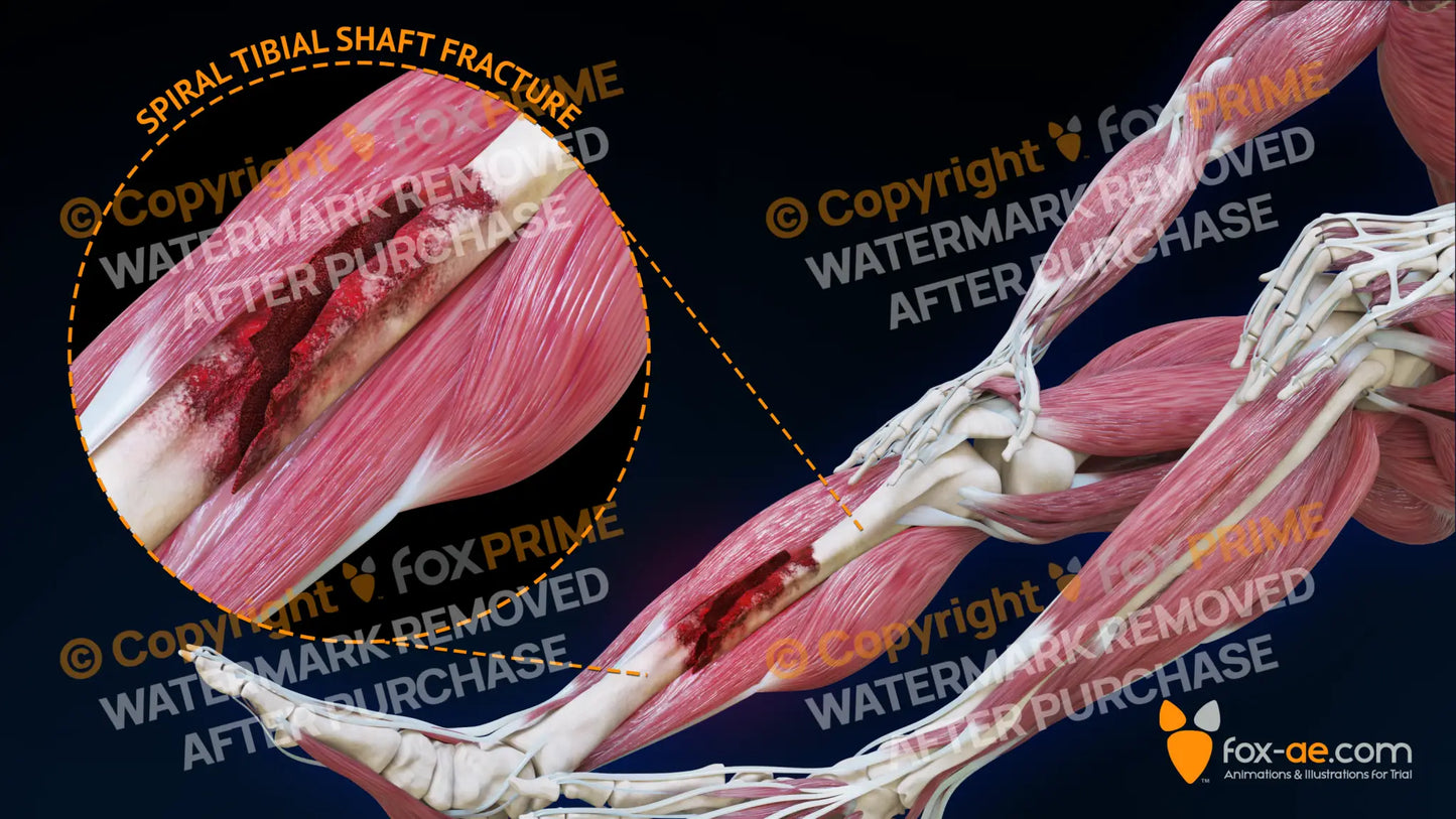 Right Spiral Tibial Shaft Fracture Still Shot