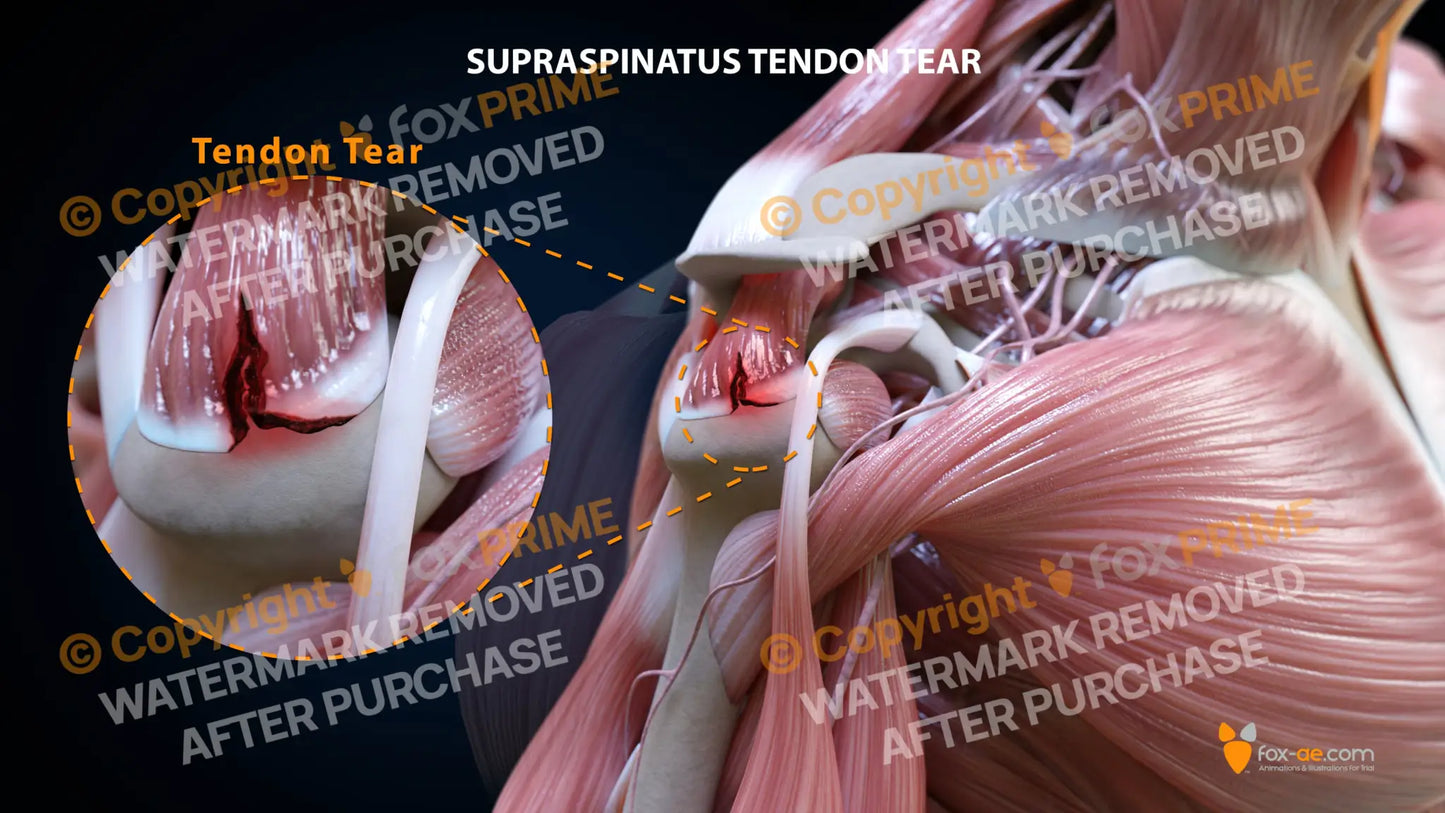 Right L Shape Tear Still Shot