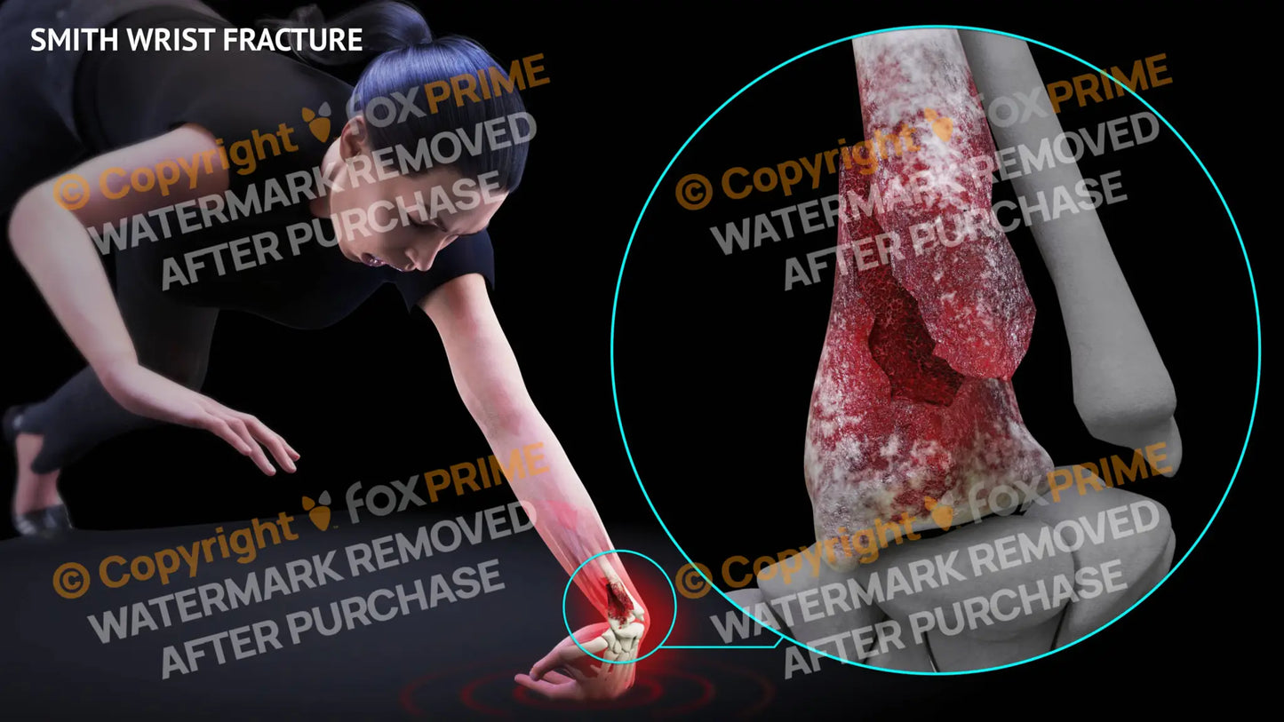 Smith Wrist Fracture Single Use / Female / Light Still Shot