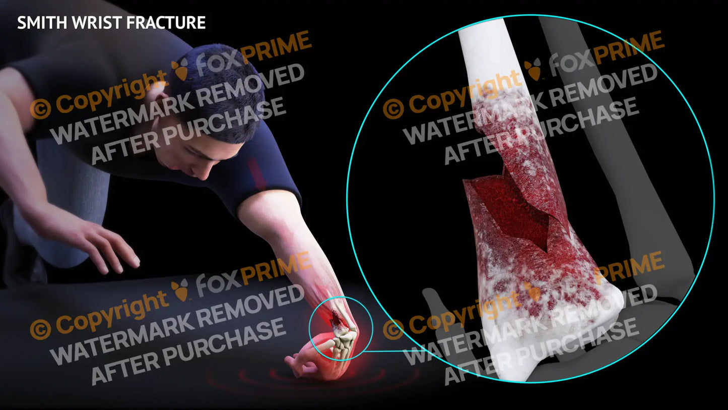Smith Wrist Fracture Single Use / Male / Light Still Shot