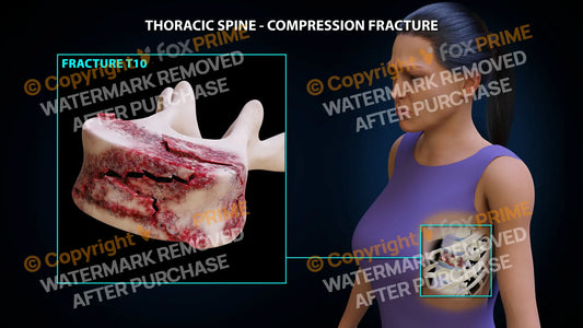 T10 Compression Fracture Single Use / Female / Light Still Shot