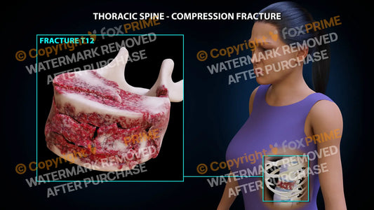 T12 Compression Fracture Single Use / Female / Light Still Shot