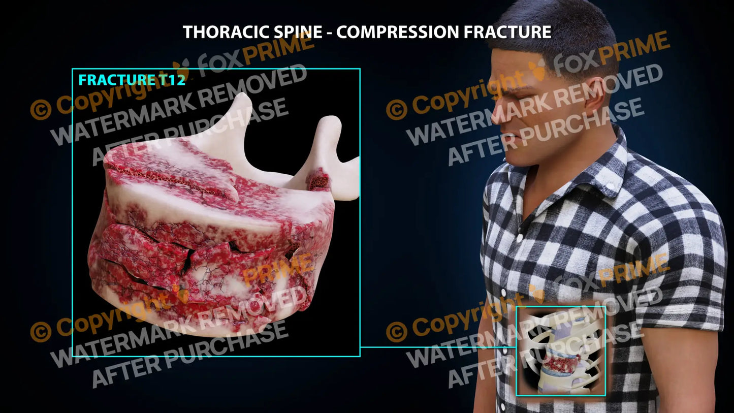 T12 Compression Fracture Single Use / Male / Light Still Shot