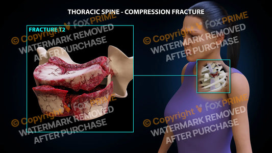 T2 Compression Fracture Single Use / Female / Light Still Shot