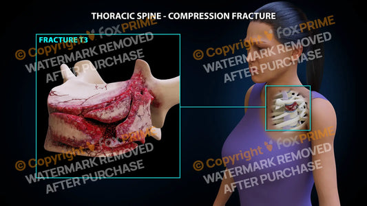 T3 Compression Fracture Single Use / Female / Light Still Shot