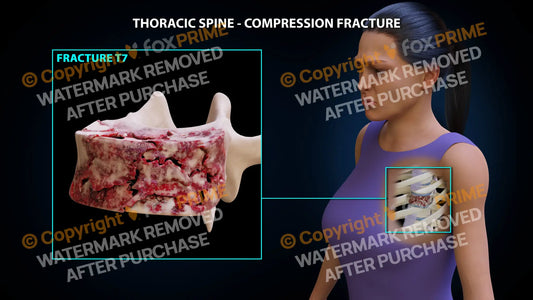 T7 Compression Fracture Single Use / Female / Light Still Shot