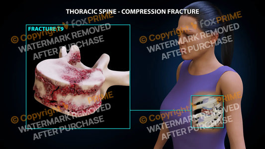 T9 Compression Fracture Single Use / Female / Light Still Shot