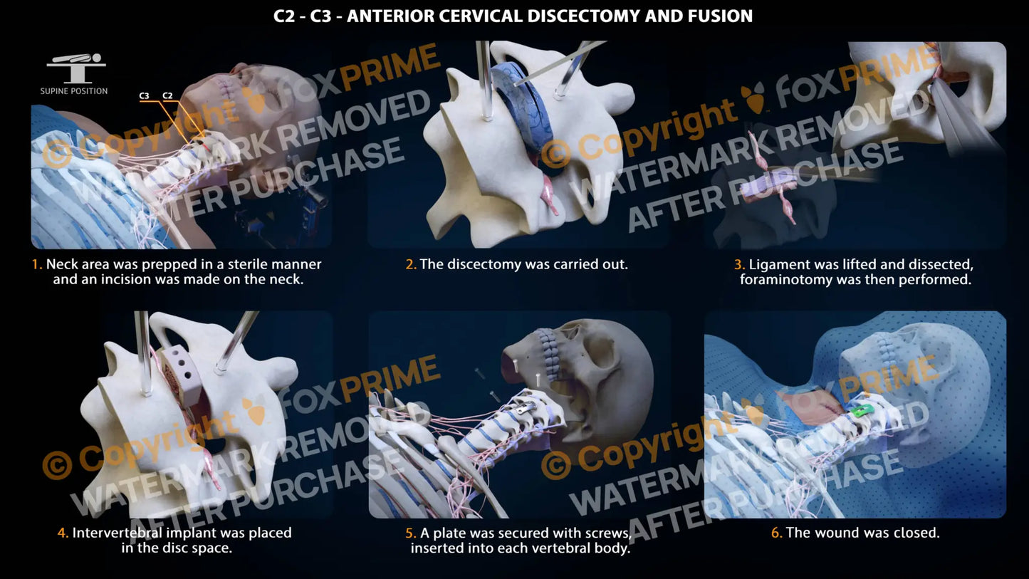 Anterior Cervical Discectomy And Fusion Left C2-C3 Single Use / Female Light Still Shot