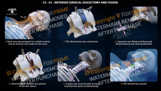 Anterior Cervical Discectomy And Fusion Left C3-C4 Single Use / Female Light Still Shot