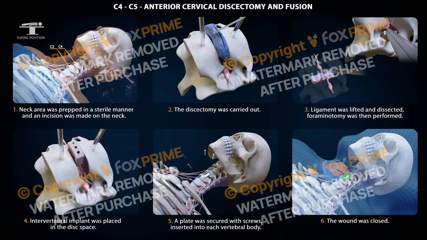 Anterior Cervical Discectomy And Fusion Left C4-C5 Single Use / Female Light Still Shot