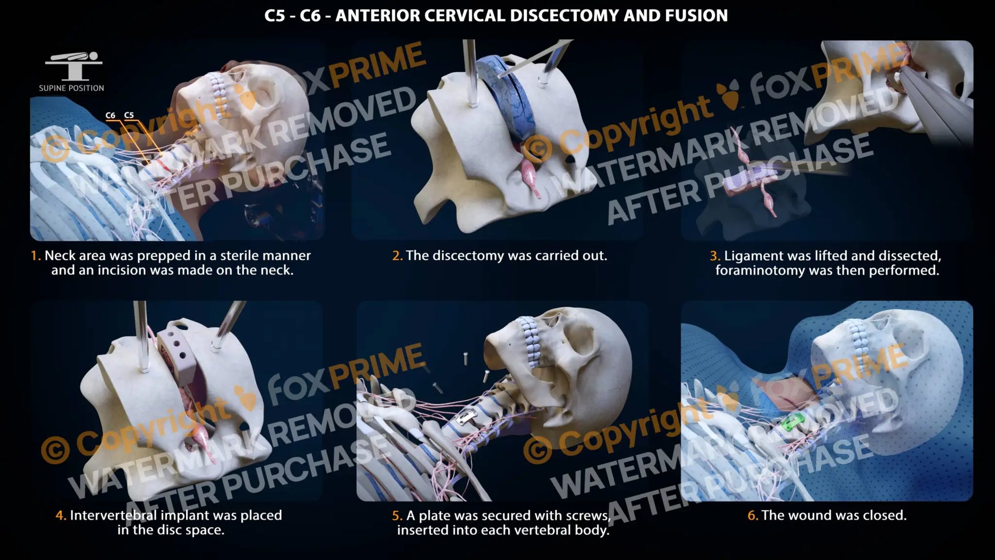 Anterior Cervical Discectomy And Fusion Left C5-C6 Single Use / Male Light Still Shot