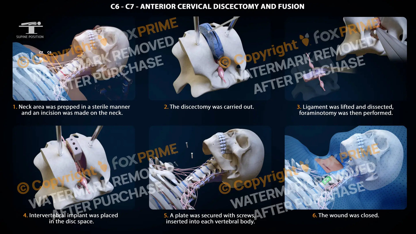 Anterior Cervical Discectomy And Fusion Left C6-C7 Single Use / Female Light Still Shot