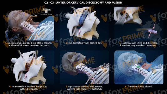 Anterior Cervical Discectomy And Fusion Right C2-C3 Single Use / Male Light Still Shot