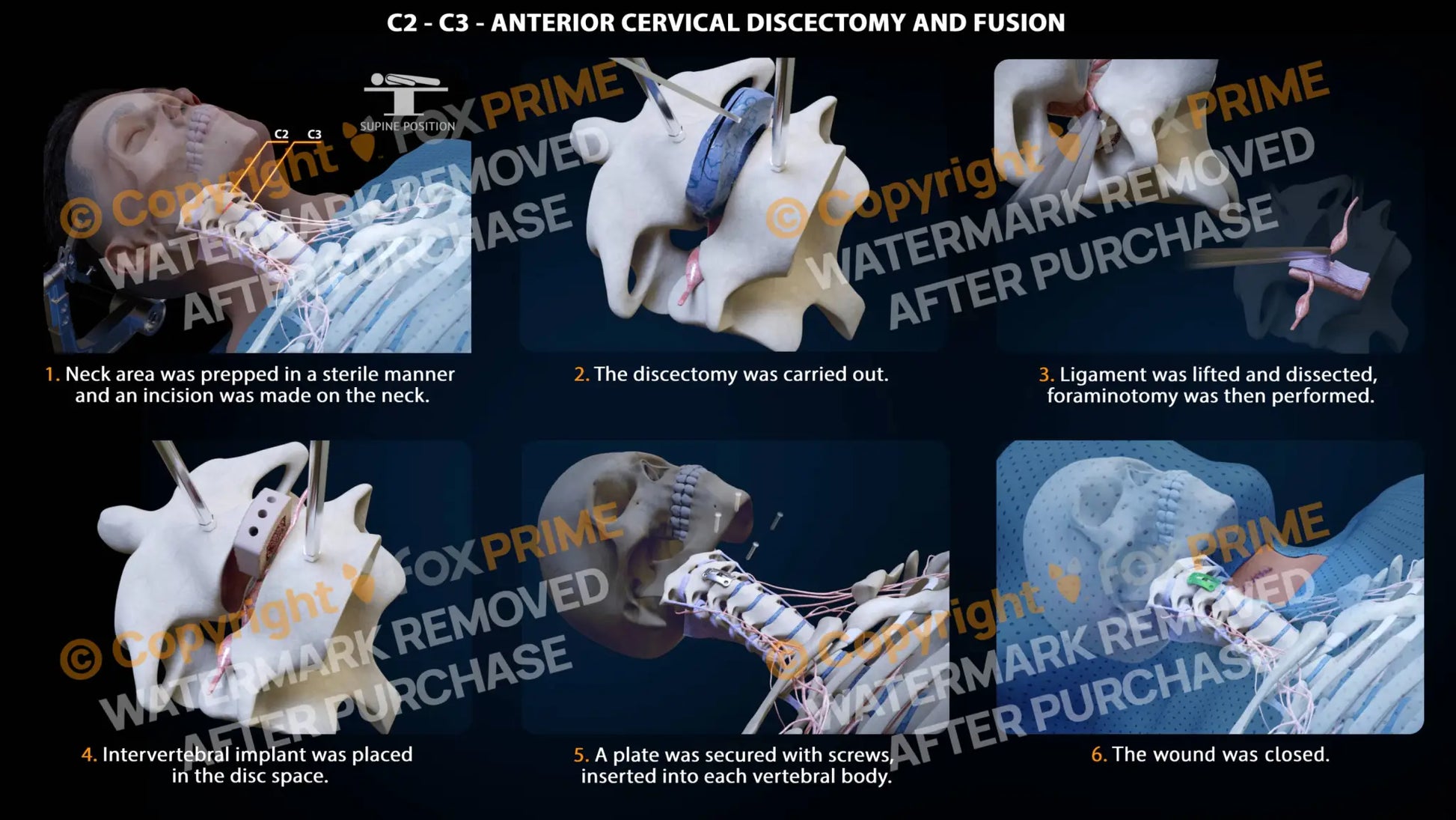 Anterior Cervical Discectomy And Fusion Right C2-C3 Single Use / Male Light Still Shot