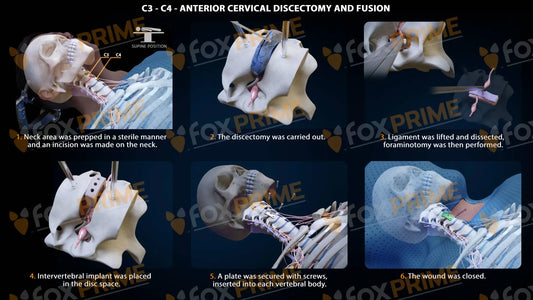 Anterior Cervical Discectomy And Fusion Right C3-C4 Single Use / Male Light Still Shot