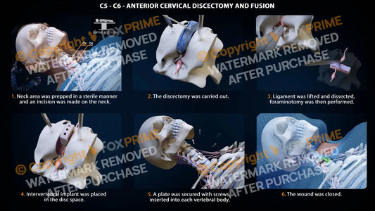 Anterior Cervical Discectomy And Fusion Right C5-C6 Single Use / Male Light Still Shot