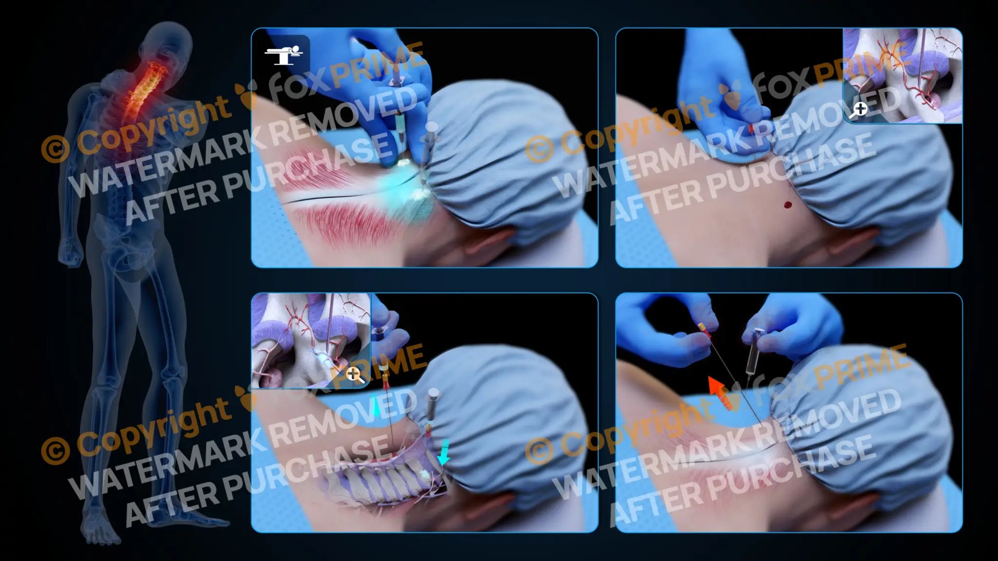 Bilateral Medial Branch Block C2-C3 (No Text) - Still Shot