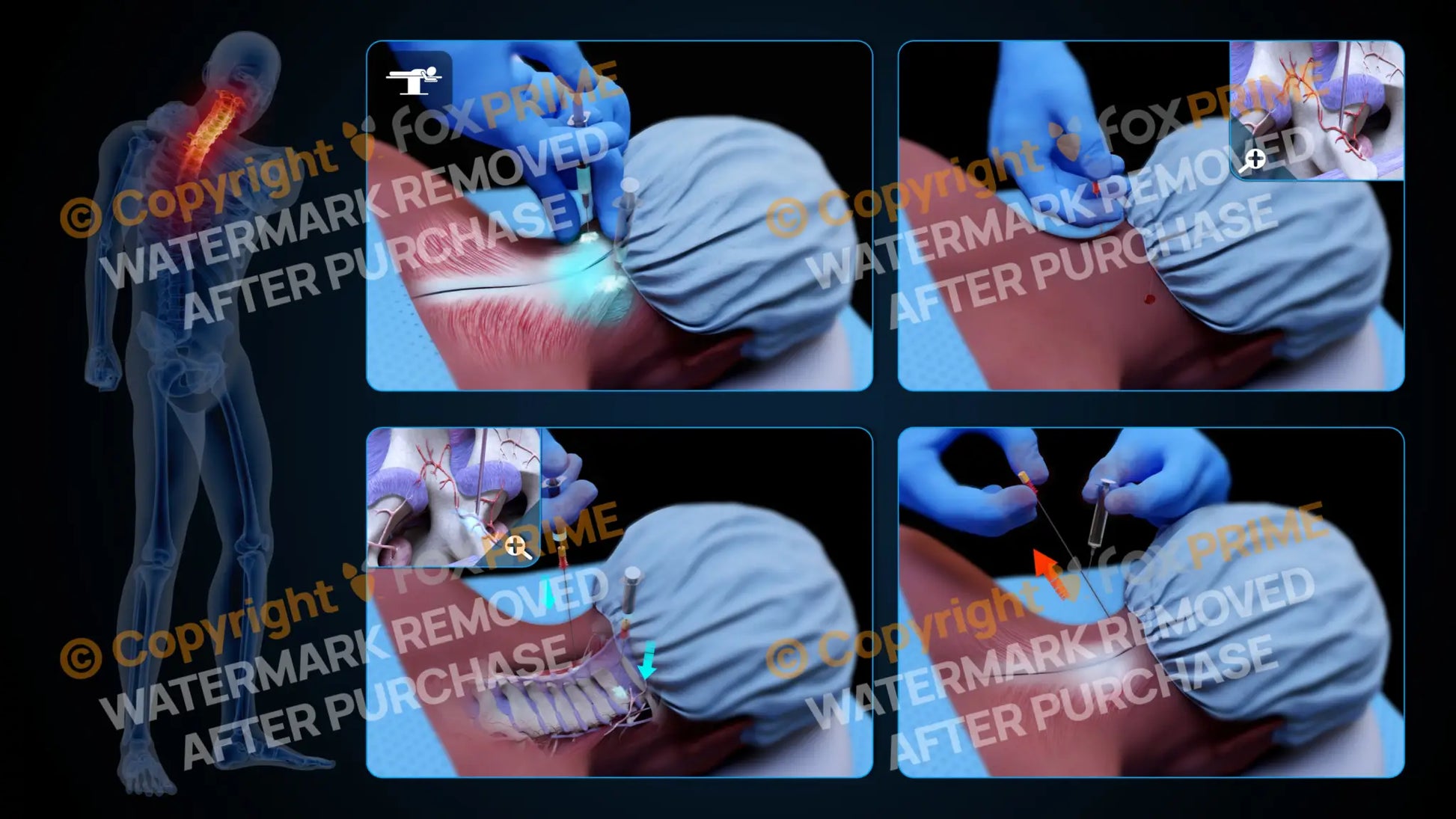 Bilateral Medial Branch Block C2-C3 (No Text) - Still Shot