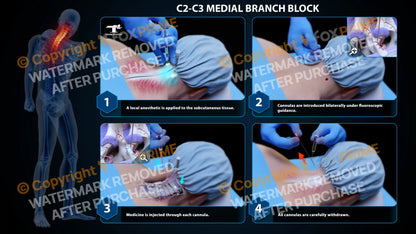 Bilateral Medial Branch Block C2-C3 (PowerPoint) - PowerPoint