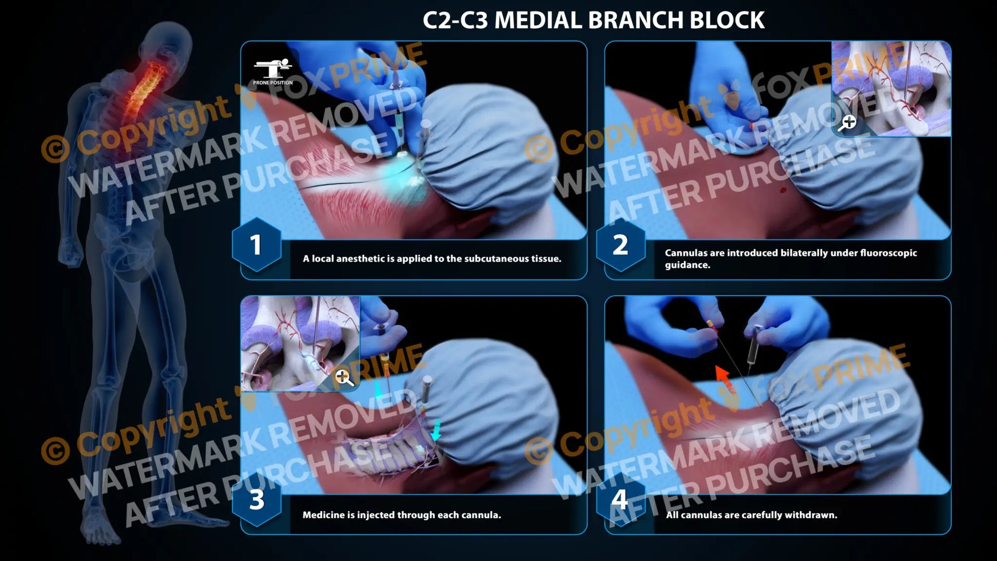 Bilateral Medial Branch Block C2-C3 (PowerPoint) - PowerPoint