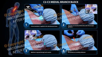 Bilateral Medial Branch Block C2-C3 (PowerPoint) - PowerPoint
