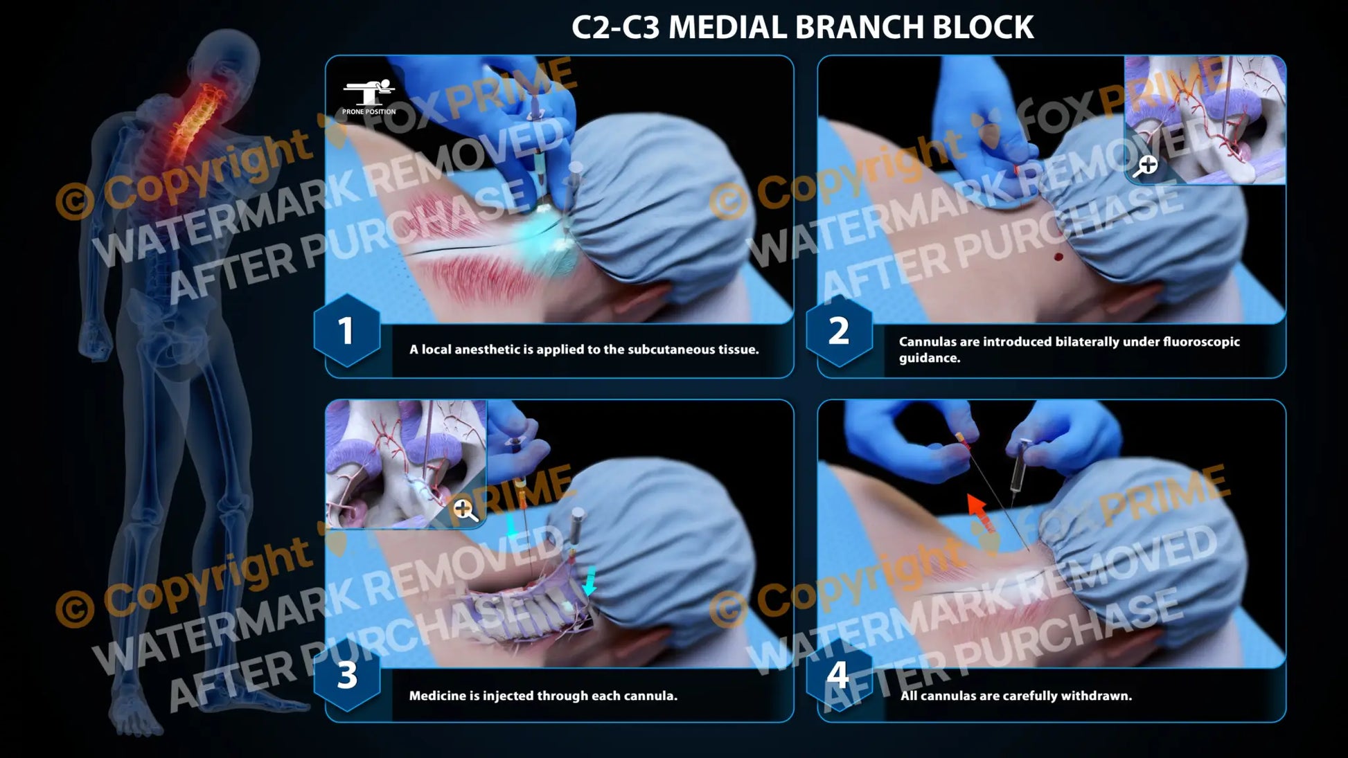 Bilateral Medial Branch Block C2-C3 - Still Shot