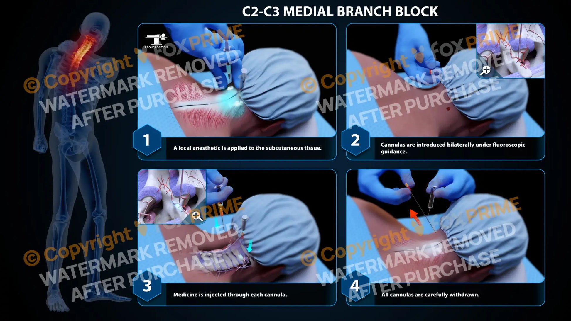 Bilateral Medial Branch Block C2-C3 - Still Shot