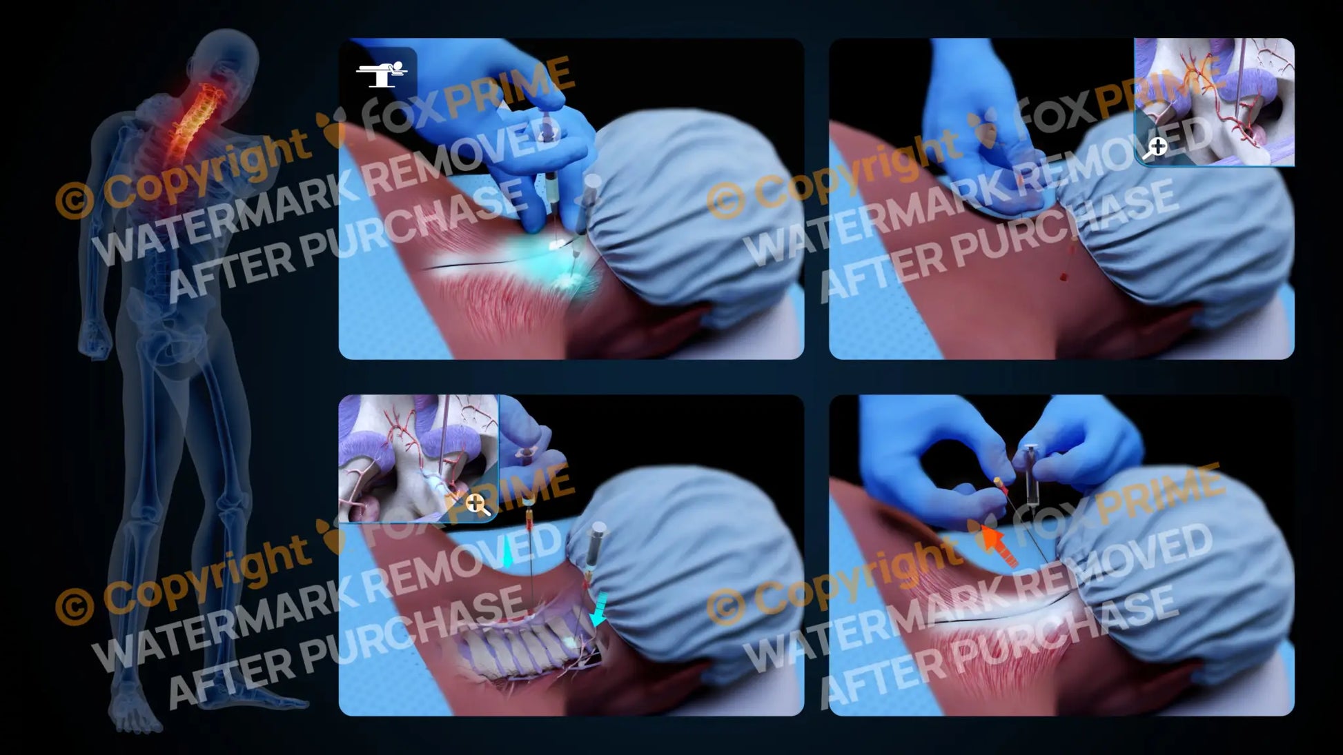 Bilateral Medial Branch Block C3-C4 (No Text) - Still Shot