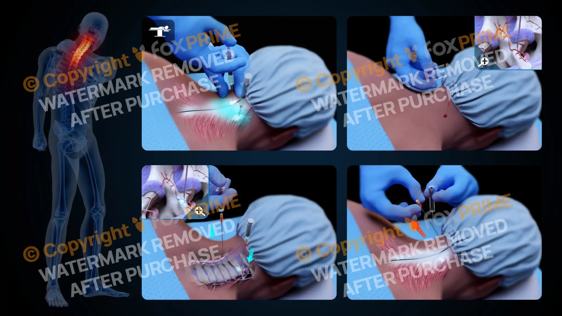 Bilateral Medial Branch Block C3-C4 (No Text) - Still Shot