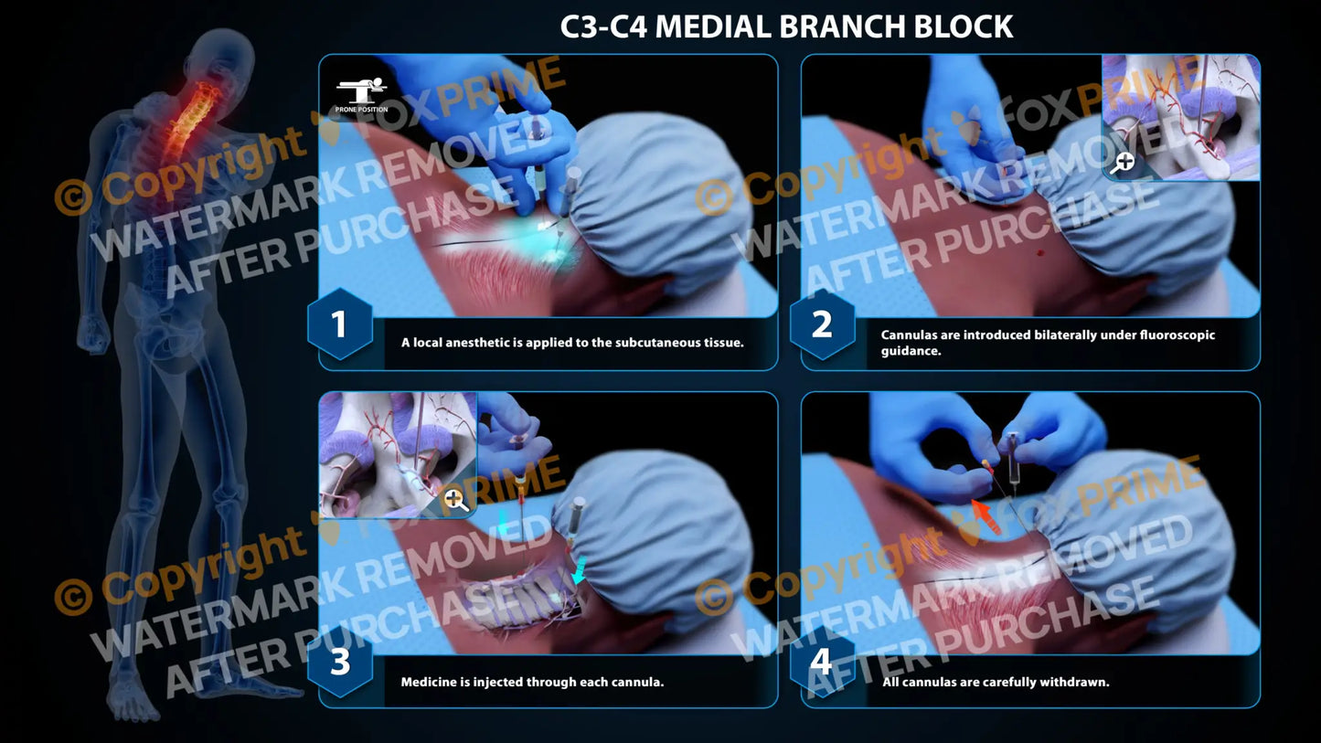 Bilateral Medial Branch Block C3-C4 (PowerPoint) - PowerPoint