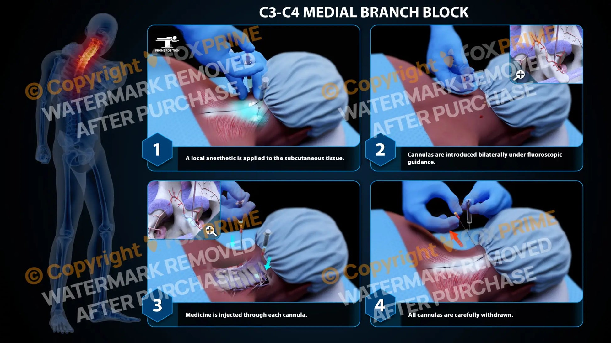 Bilateral Medial Branch Block C3-C4 (PowerPoint) - PowerPoint