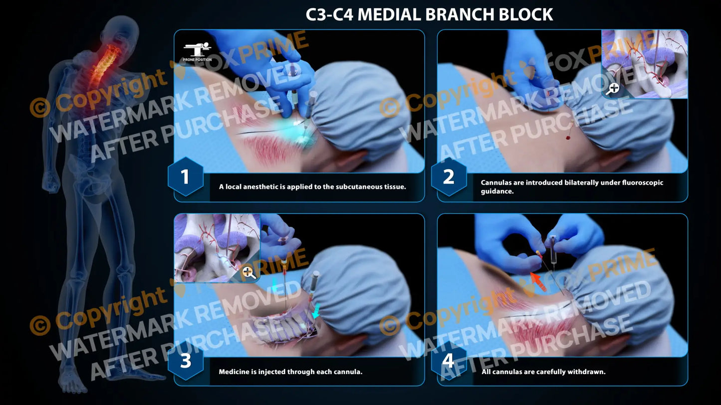 Bilateral Medial Branch Block C3-C4 (PowerPoint) - PowerPoint