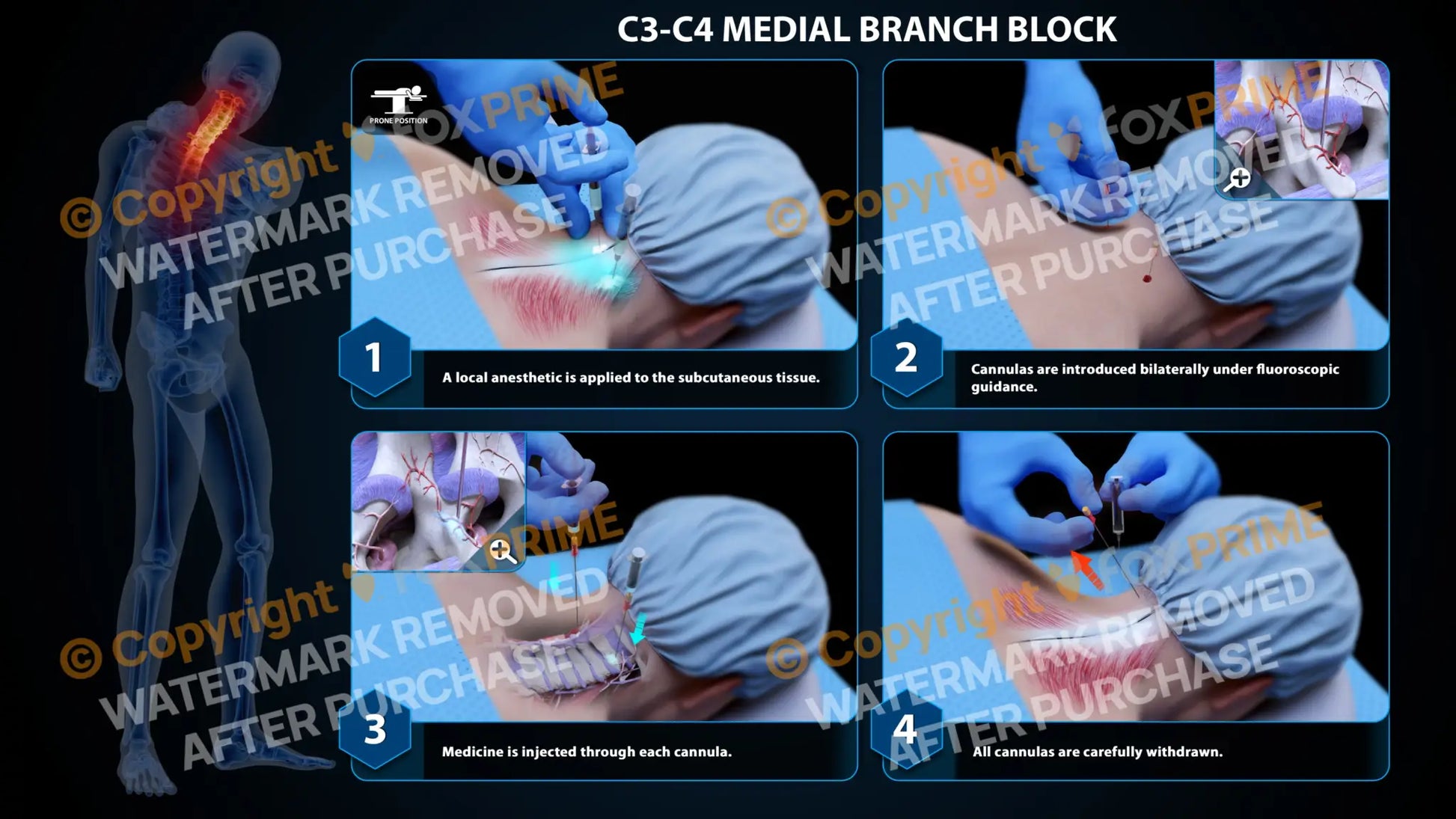 Bilateral Medial Branch Block C3-C4 (PowerPoint) - PowerPoint