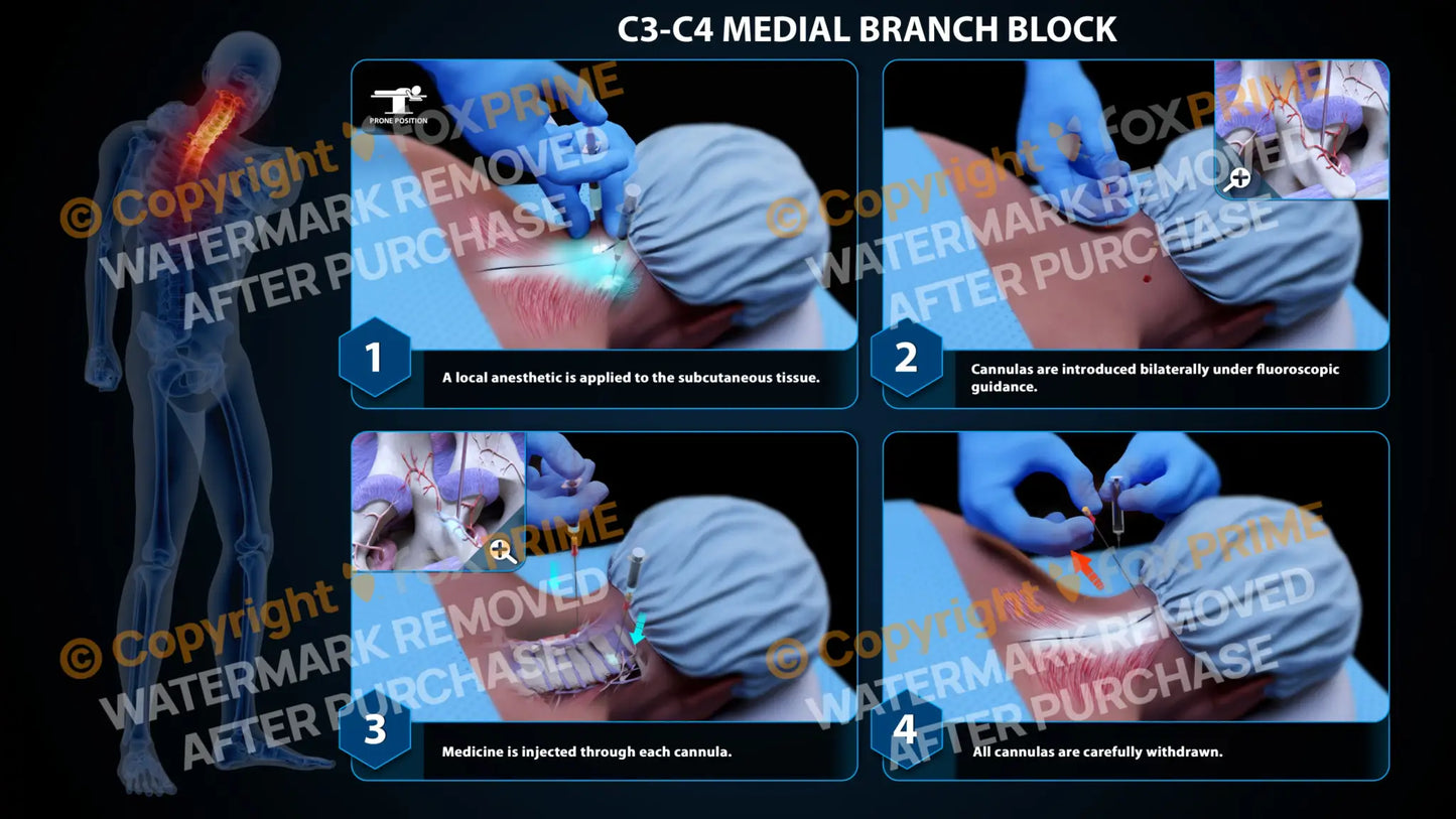 Bilateral Medial Branch Block C3-C4 (PowerPoint) - PowerPoint
