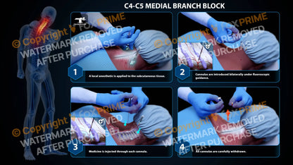 Bilateral Medial Branch Block C4-C5 (PowerPoint) - PowerPoint