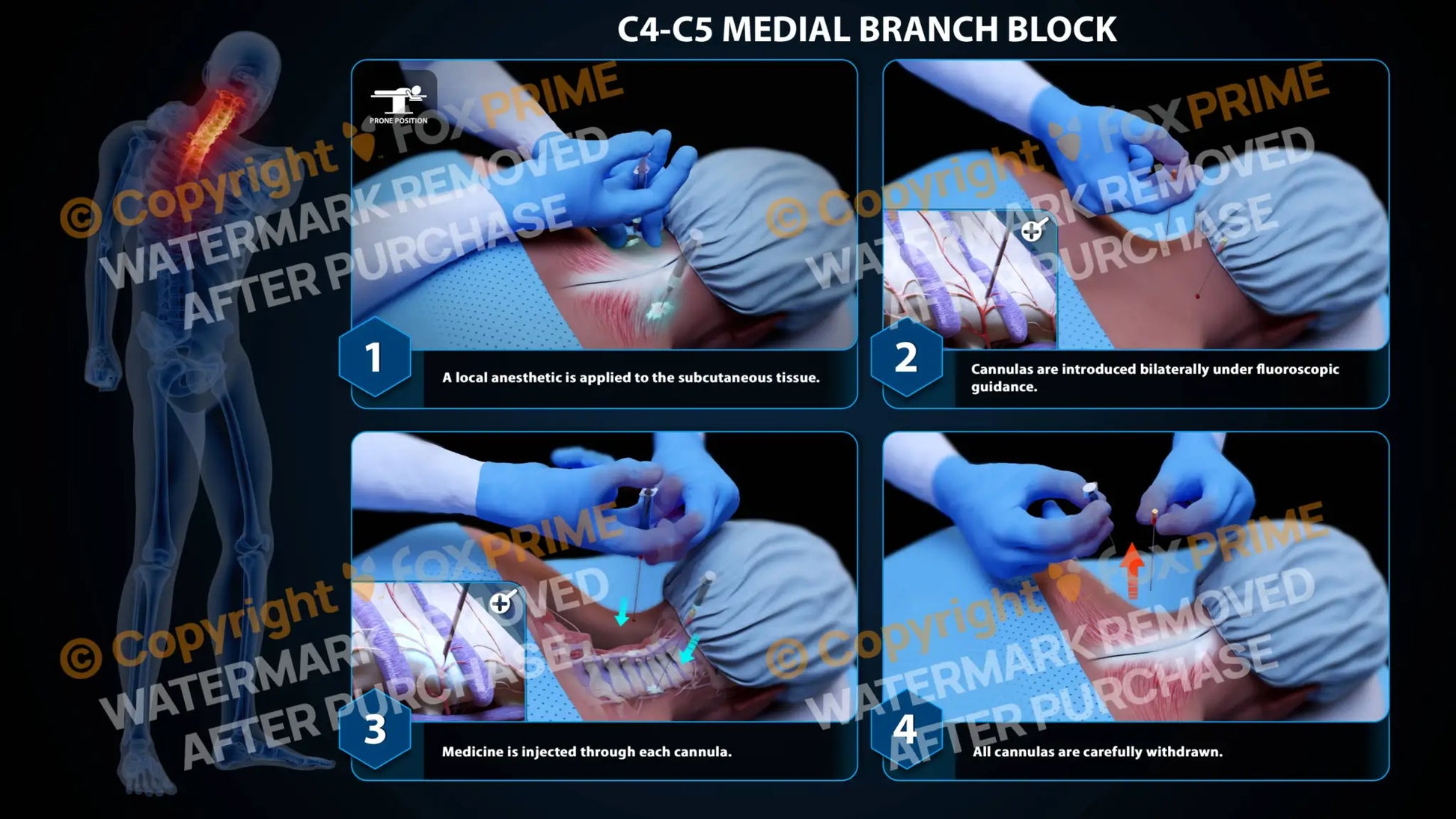 Bilateral Medial Branch Block C4-C5 (PowerPoint) - PowerPoint