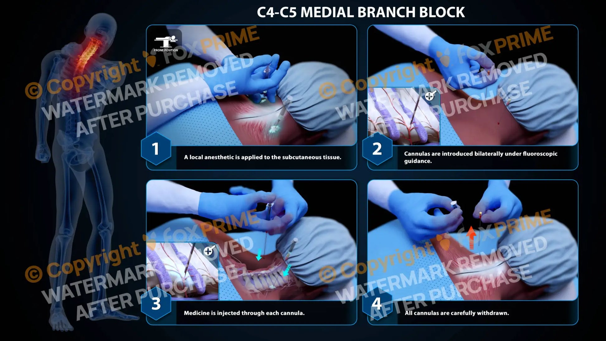 Bilateral Medial Branch Block C4-C5 - Still Shot