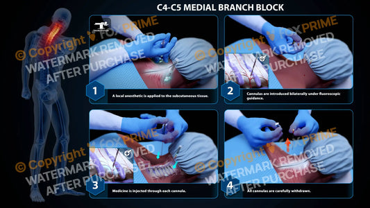 Bilateral Medial Branch Block C4-C5 - Still Shot