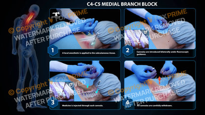 Bilateral Medial Branch Block C4-C5 - Still Shot