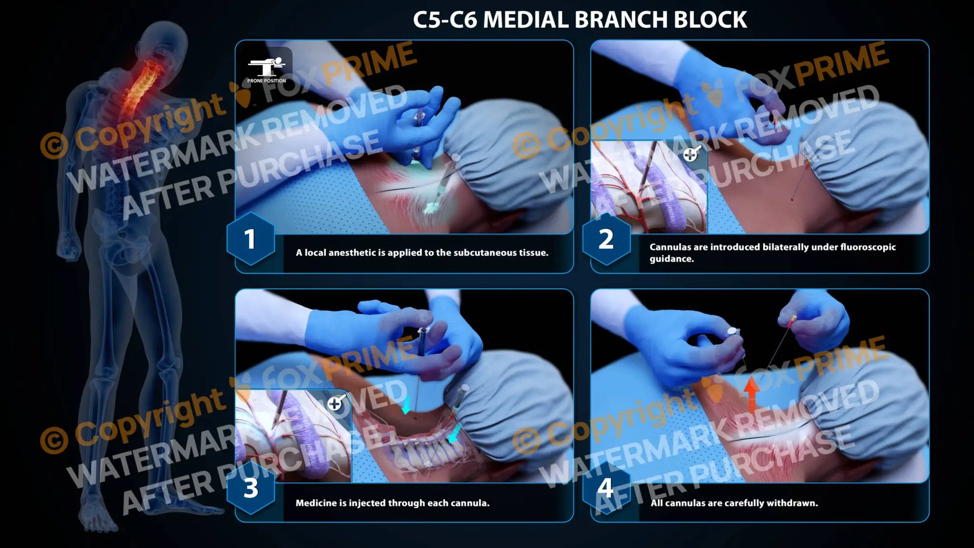 Bilateral Medial Branch Block C5-C6 - Still Shot
