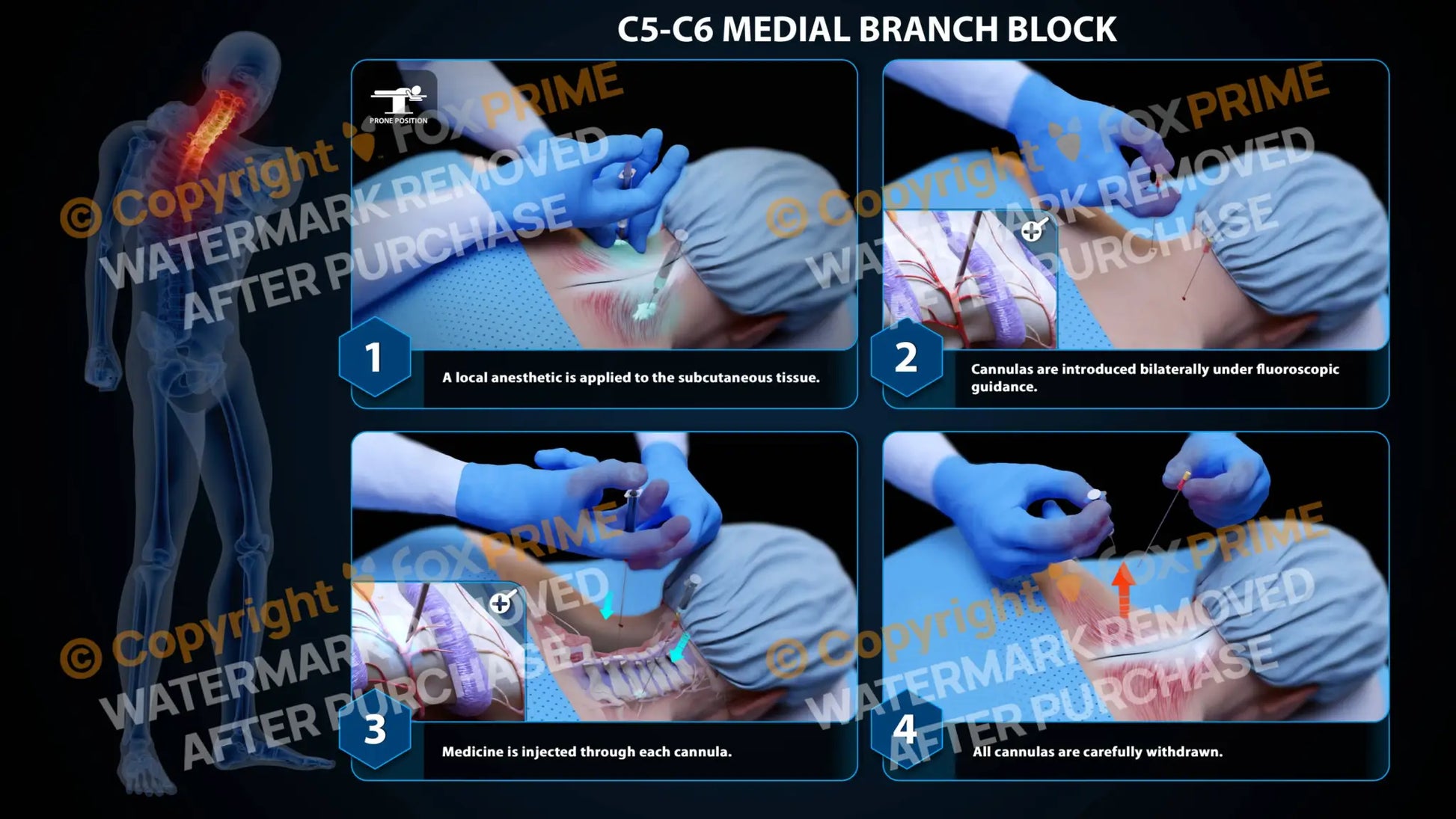 Bilateral Medial Branch Block C5-C6 - Still Shot