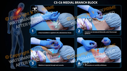 Bilateral Medial Branch Block C5-C6 - Still Shot