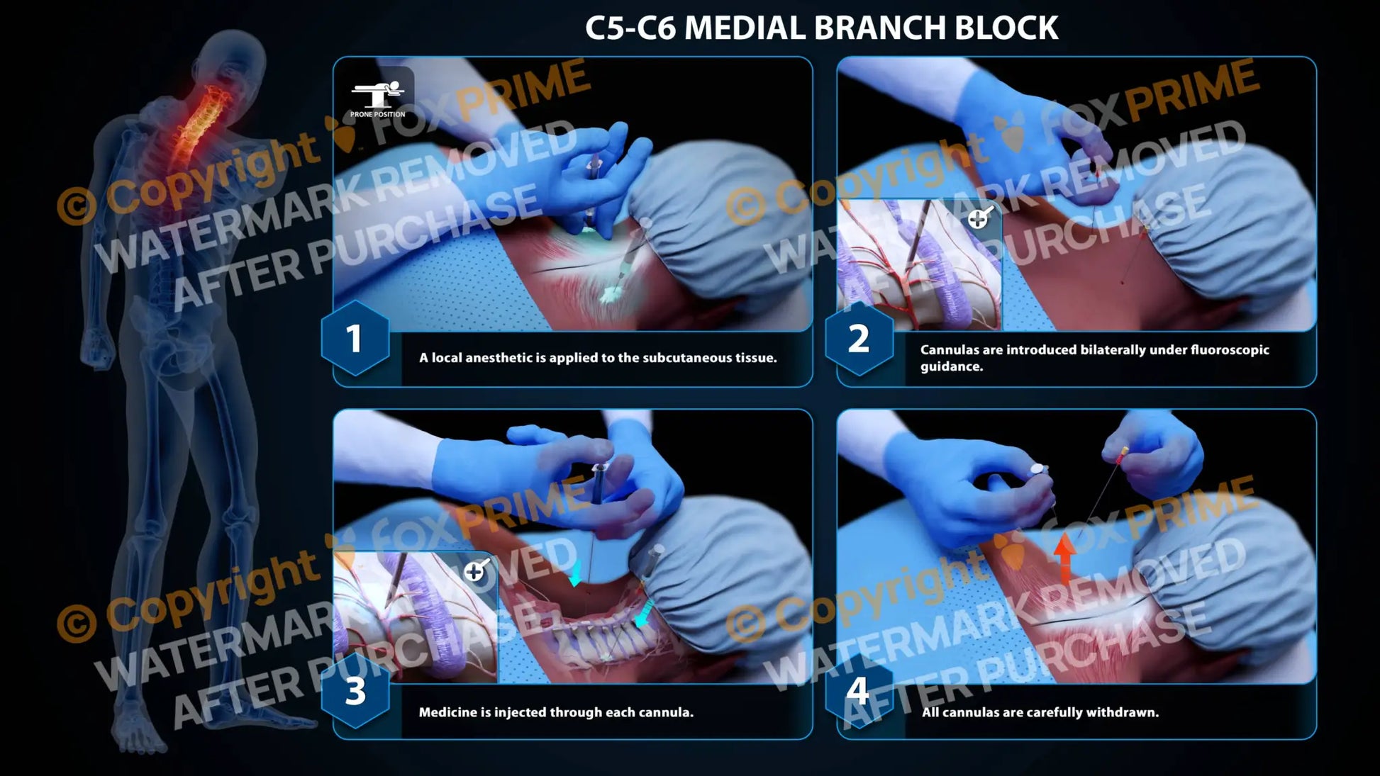 Bilateral Medial Branch Block C5-C6 - Still Shot